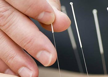 UB Acupuncture MS student using needles