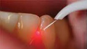 closeup of laser work being done on teeth