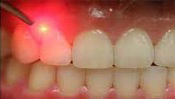 closeup of laser work being done on teeth